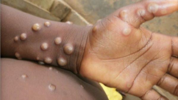 研究人员:8岁以下儿童猴痘风险更高